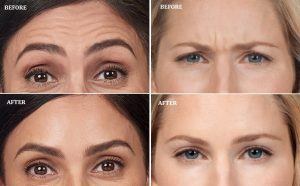 Before and after images showing the benefits of botox.