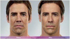 Before and after image showing the benefits of fillers.