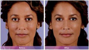 Before and after image showing the benefits of fillers.