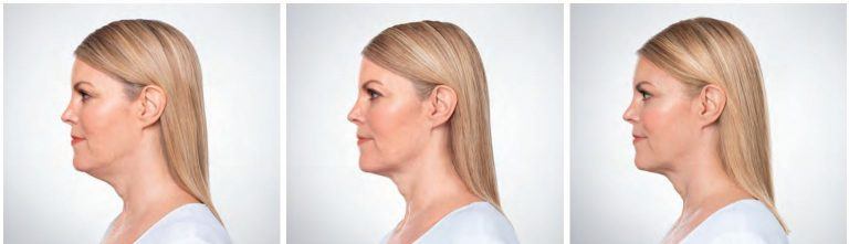 Lady with before and after shots at 61Five Health and Wellness