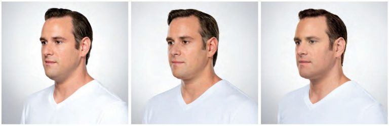 Man with before and after shots at 61Five Health and Wellness