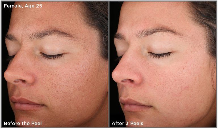 Before and after image showing the benefits of chemical peels.